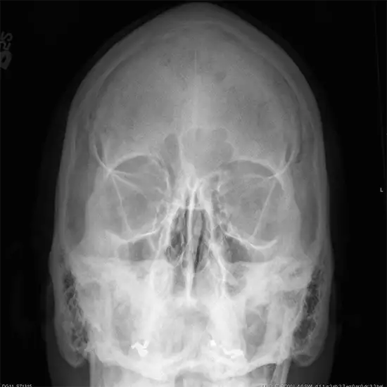 X-Ray Skull Caldwell view Procedure